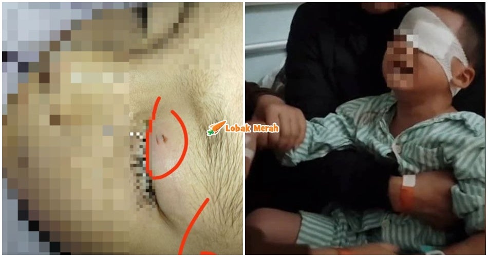 Kanak-kanak 4 Tahun Buta Sebelah Mata Sebab Guna Petua Lama Rawat Luka