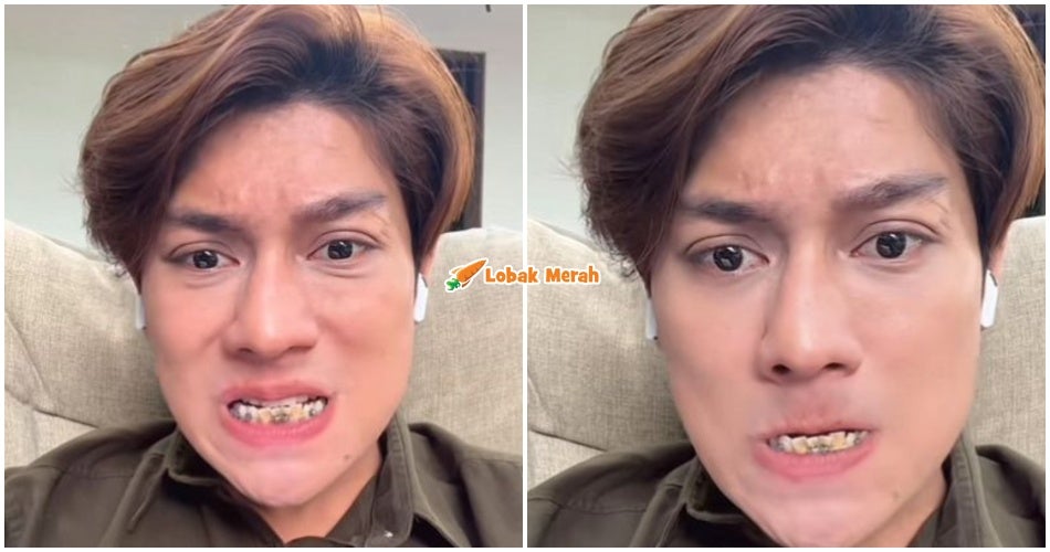 Netizen Loya Tengok Perubahan Warna Pada Gigi Rizky Billar Sejak Pakai Braces
