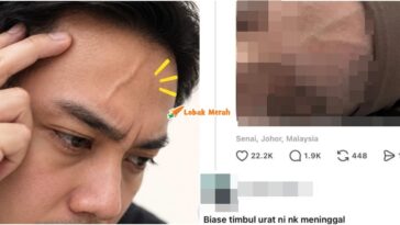 Urat Timbul Dahi Petanda Ajal