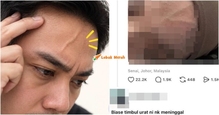 Urat Timbul Dahi Petanda Ajal